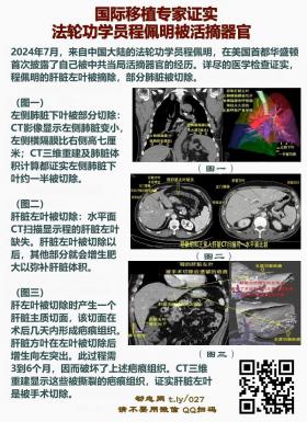 国际移植专家证实 法轮功学员程佩明被活摘器官